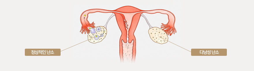 다낭성 난소증후군은 가임기 여성의 약 4-7% 정도에서 발생하는 내분비질환으로. 여성에게 불규칙적인 월경을 유발하고 남성 호르몬이 증가되는 상태를 말합니다. 정상난소, 다낭성난소