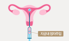 인공수정이란 최소 한쪽 이상의 나팔관이 정상인 여성에서 자궁내에 운동성이 향상된 정자를 직접 주입하여 임신율을 향상키는 방법입니다. 이는 여성의 체내에서 배란과 수정이 이루어지는 자연적인 방법이며, 체외수정 (시험관아기,IVF)보다 훨씬 간단한 방법 입니다.